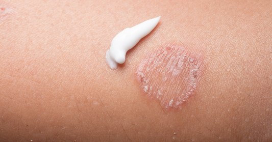 How Psoriasis Affects the Body (and Why Creams Aren’t Enough)