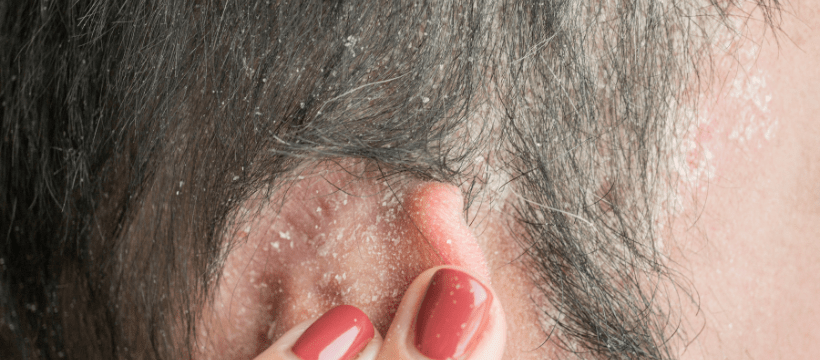 How to Cure Scalp Psoriasis Permanently - Strength & Spices Ltd.