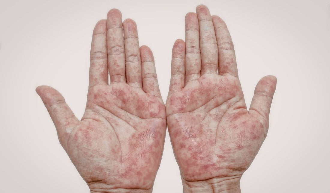 Supplements for Psoriasis Support That Make Sense