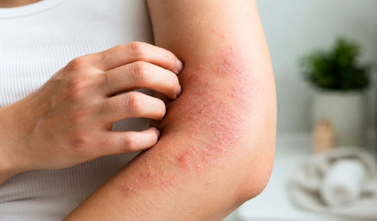 What Helps Recurring Skin Flare Ups?